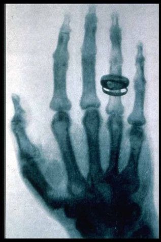 Roentgen’s hand